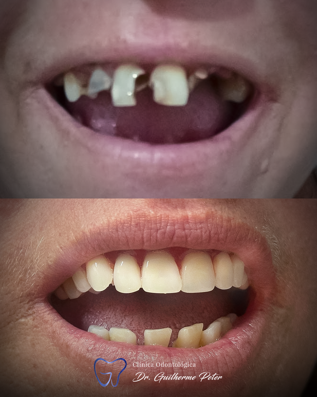 Resultado antes e depois 1