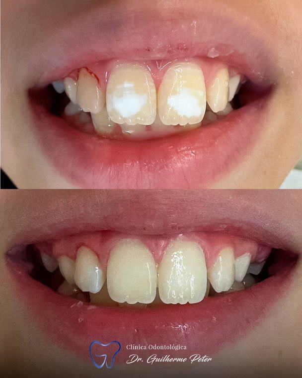 Caso clínico realizado na Clínica Odontológica Dr. Guilherme Peter 10