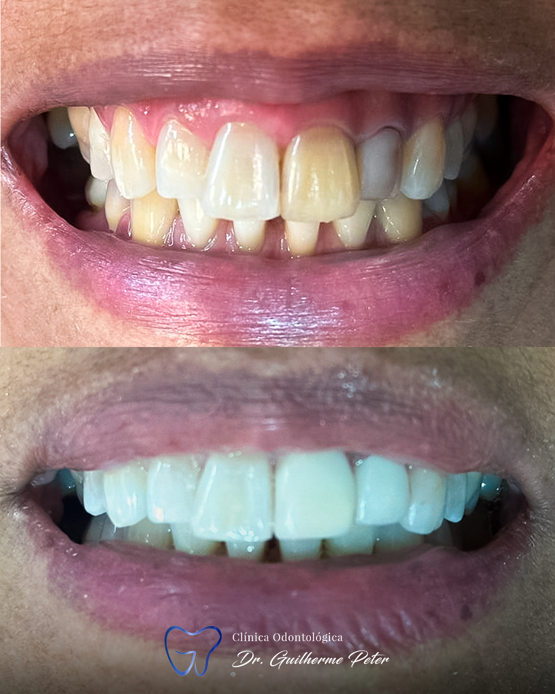Resultado antes e depois 2