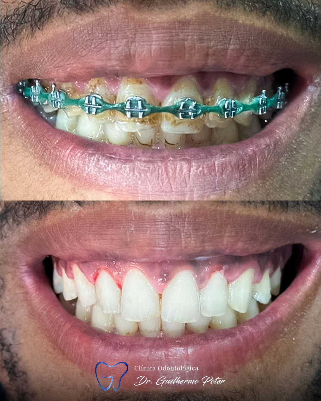 Resultado antes e depois 4