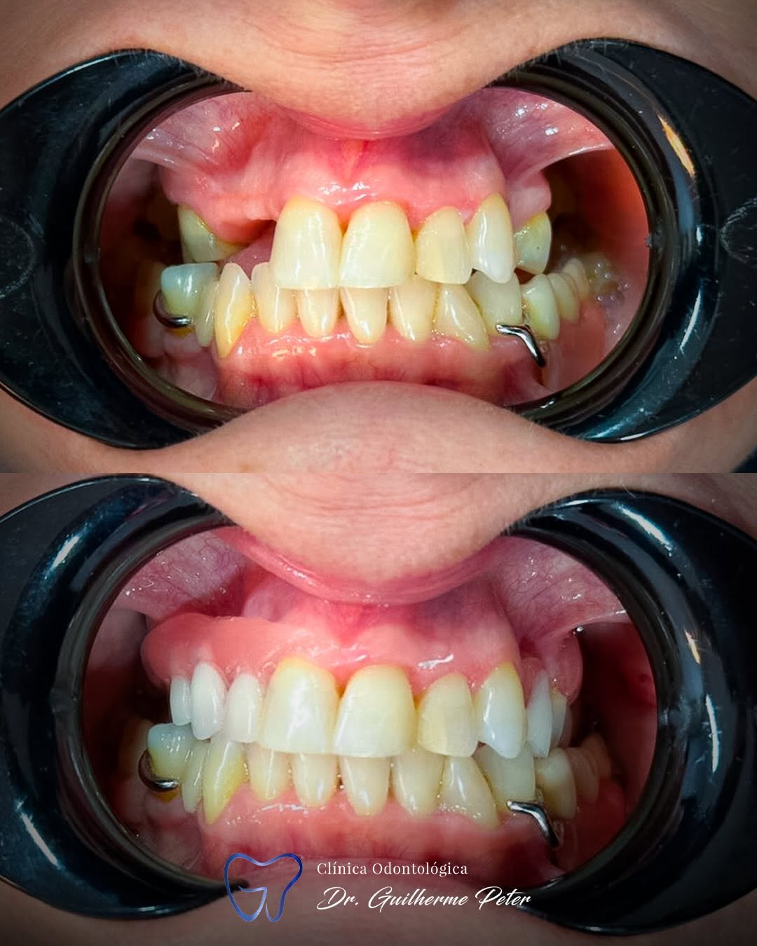 Resultado antes e depois 6
